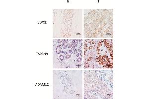 Representative IHC of non-neoplastic (N) and triple-negative breast cancer (T) tissues of VWCE, TSPAN9 and ADAM12 proteins. (ADAM12 antibody  (AA 589-738))