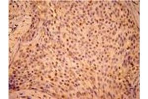 Immunohistochemistry analysis of human breast cancer tissue with Hsp27 (pSer15) pAb (HSP27 antibody  (pSer15))