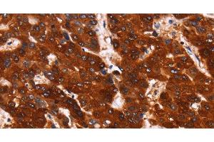 Immunohistochemistry of paraffin-embedded Human liver cancer using GPR124 Polyclonal Antibody at dilution of 1:40 (GPR124 antibody)