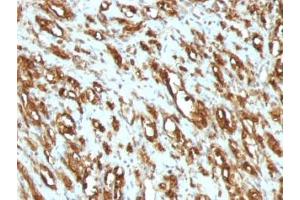 Formalin-fixed, paraffin-embedded human rhabdomyosarcoma stained with pan Muscle Actin antibody (MSA/953) (Pan Muscle Actin antibody)