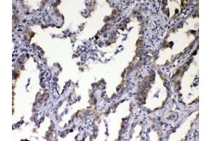 IHC testing of FFPE human lung cancer tissue with CCN3 antibody at 1ug/ml. (NOV antibody  (AA 334-357))