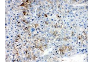 IHC testing of FFPE human liver cancer tissue with AKR1B10 antibody at 1ug/ml. (AKR1B10 antibody  (AA 285-316))