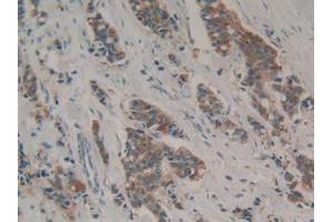 IHC-P analysis of Human Breast Cancer Tissue, with DAB staining. (GAL3ST1 antibody  (AA 57-196))