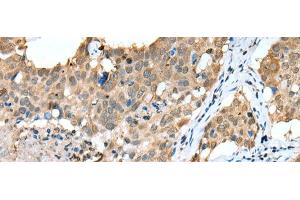 Immunohistochemistry of paraffin-embedded Human lung cancer tissue using SPRY4 Polyclonal Antibody at dilution of 1:25(x200) (SPRY4 antibody)