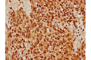 IHC image of ABIN7170790 diluted at 1:500 and staining in paraffin-embedded human ovarian cancer performed on a Leica BondTM system. (STRA8 antibody  (AA 115-241))