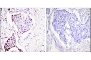 Immunohistochemistry analysis of paraffin-embedded human breast carcinoma tissue, using Ubiquitin Antibody. (Ubiquitin antibody  (AA 40-89))