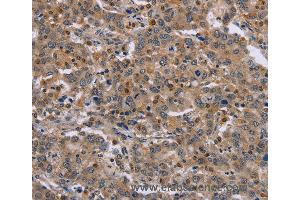 Immunohistochemistry of Human liver cancer using ETV7 Polyclonal Antibody at dilution of 1:30 (ETV7 antibody)