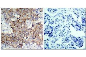Immunohistochemical analysis of paraffin-embedded human breast carcinoma tissue, using HER2(Phospho-Tyr877) Antibody(left) or the same antibody preincubated with blocking peptide(right). (ErbB2/Her2 antibody  (pTyr877))
