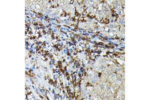 Immunohistochemistry of paraffin-embedded Human liver cancer using HLA-DPB1 antibody (ABIN7268370) at dilution of 1:100 (40x lens). (HLA-DPB1 antibody)