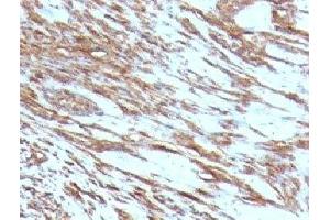 Formalin-fixed, paraffin-embedded human leiomyosarcoma stained with pan Muscle Actin antibody (MSA/953) (Pan Muscle Actin antibody)