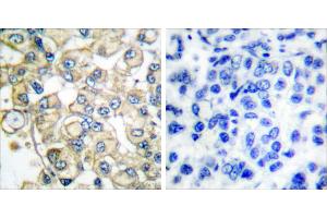 Peptide - +Immunohistochemical analysis of paraffin-embedded human breast carcinoma tissue using FGFR1 Oncogene Partner antibody (#C0190). (FGFR1OP antibody)