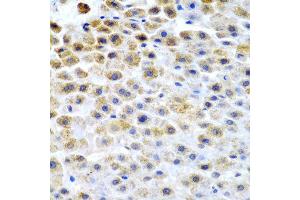 Immunohistochemistry of paraffin-embedded human liver cancer using TFPI2 antibody at dilution of 1:200 (40x lens). (TFPI2 antibody)