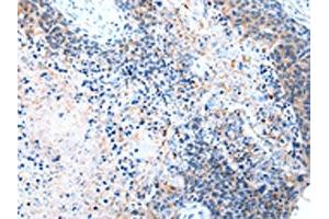 The image on the left is immunohistochemistry of paraffin-embedded Human esophagus cancer tissue using ABIN7190332(COLEC12 Antibody) at dilution 1/40, on the right is treated with synthetic peptide. (COLEC12 antibody)