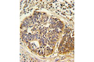 Formalin-fixed and paraffin-embedded human lung carcinoma reacted with HMGCS1 Antibody , which was peroxidase-conjugated to the secondary antibody, followed by DAB staining. (HMGCS1 antibody  (C-Term))