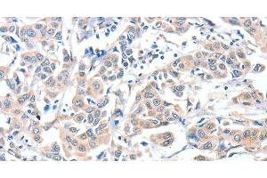 Immunohistochemistry of paraffin-embedded Human breast cancer using CD156c Polyclonal Antibody at dilution of 1:30 (ADAM10 antibody)