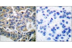 Immunohistochemistry analysis of paraffin-embedded human breast carcinoma tissue, using eEF2K (Ab-366) Antibody. (EEF2K antibody  (AA 331-380))