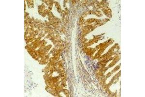 Immunohistochemical analysis of CD184 staining in human breast cancer,human tonsil formalin fixed paraffin embedded tissue section. (CXCR4 antibody)