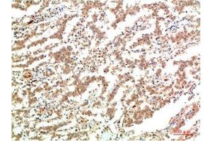 Immunohistochemical analysis of paraffin-embedded Human Lung Carcinoma Tissue using JAK2 Mouse mAb diluted at 1:200. (JAK2 antibody)