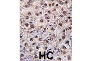 Formalin-fixed and paraffin-embedded human hepatocarcinoma tissue reacted with PEMT antibody (N-term) (ABIN650614 and ABIN2844055) , which was peroxidase-conjugated to the secondary antibody, followed by DAB staining. (PEMT antibody  (N-Term))