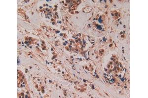 IHC-P analysis of breast cancer tissue, with DAB staining. (ADAMTS5 antibody  (AA 485-622))