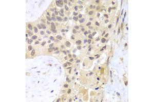 Immunohistochemistry of paraffin-embedded human lung cancer using PSMC5 antibody (ABIN6293149) at dilution of 1:100 (40x lens). (PSMC5 antibody)