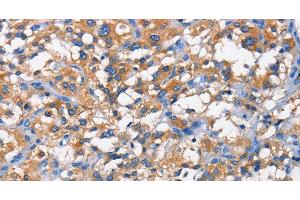 Immunohistochemistry of paraffin-embedded Human thyroid cancer tissue using PFKP Polyclonal Antibody at dilution 1:50 (PFKP antibody)