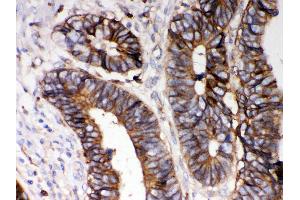 Anti- HLA-A Picoband antibody,IHC(P) IHC(P): Human Intestinal Cancer Tissue (HLA-A antibody  (N-Term))