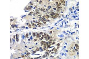 Immunohistochemistry of paraffin-embedded Human colon carcinoma using DACH1 Polyclonal Antibody at dilution of 1:100 (40x lens). (DACH1 antibody)
