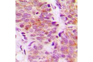 Immunohistochemical analysis of S6K1 staining in human breast cancer formalin fixed paraffin embedded tissue section. (RPS6KB1 antibody  (C-Term))