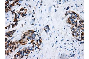 Immunohistochemical staining of paraffin-embedded Adenocarcinoma of breast tissue using anti-HSD17B10 mouse monoclonal antibody. (HSD17B10 antibody)