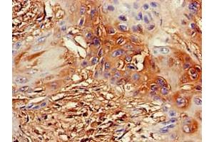 Immunohistochemistry of paraffin-embedded human cervical cancer using ABIN7164355 at dilution of 1:100 (DDX4 antibody  (AA 1-223))