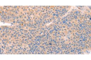 Immunohistochemistry of paraffin-embedded Human liver cancer tissue using CD109 Polyclonal Antibody at dilution 1:30 (CD109 antibody)
