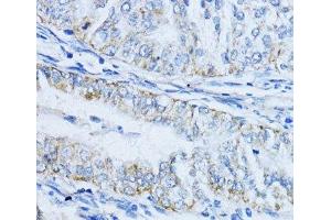 Immunohistochemistry of paraffin-embedded Human colon carcinoma using VIL1 Polyclonal Antibody at dilution of 1:100 (40x lens). (Villin 1 antibody)