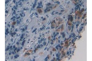 DAB staining on IHC-P; Samples: Human Breast cancer Tissue (HSD17B1 antibody  (AA 4-289))