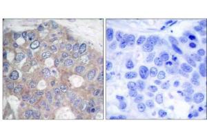 Immunohistochemical analysis of paraffin-embedded human breast carcinoma tissue using p70 S6 Kinase (Ab-421) antibody (E021246). (RPS6KB1 antibody)