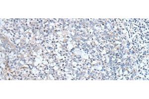 Immunohistochemistry of paraffin-embedded Human tonsil tissue using ABCD1 Polyclonal Antibody at dilution of 1:80(x200) (ABCD1 antibody)