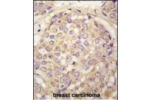 Forlin-fixed and paraffin-embedded hun breast carcino tissue reacted with GEA4 antibody (N-term) (ABIN390108 and ABIN2840620) , which was peroxidase-conjugated to the secondary antibody, followed by DAB staining. (MAGEA4 antibody  (N-Term))