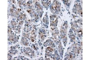 Immunohistochemical staining of paraffin-embedded Carcinoma of liver tissue using anti-SHC1 mouse monoclonal antibody. (SHC1 antibody)
