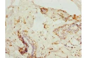 Immunohistochemistry of paraffin-embedded human breast cancer using ABIN7176183 at dilution of 1:100 (ZNF232 antibody  (AA 1-417))