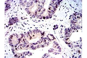 Immunohistochemical analysis of paraffin-embedded colon cancer tissues using BIRC5 mouse mAb with DAB staining. (Survivin antibody)