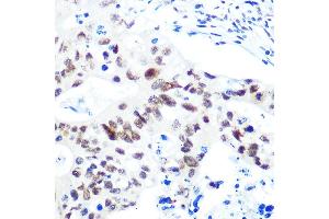 Immunohistochemistry of paraffin-embedded human colon carcinoma using HD Rabbit mAb (ABIN1680476, ABIN3015870, ABIN3015871 and ABIN7101453) at dilution of 1:100 (40x lens). (HDAC9 antibody)