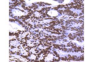 Paraformaldehyde-fixed, paraffin embedded Human breast carcinoma tissue, Antigen retrieval by boiling in sodium citrate buffer (pH6) for 15min, Block endogenous peroxidase by 3% hydrogen peroxide for 30 minutes, Blocking buffer at 37°C for 20min, Antibody incubation with Histone H3. (Histone H3.3 antibody)