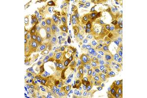 Immunohistochemistry of paraffin-embedded human liver cancer using CDK20 antibody (ABIN5971446) at dilution of 1/100 (40x lens). (CCRK antibody)