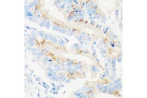 Immunohistochemistry of paraffin-embedded Human colon carcinoma using M Rabbit pAb (ABIN7268390) at dilution of 1:100 (40x lens). (MAN1A2 antibody  (AA 60-180))