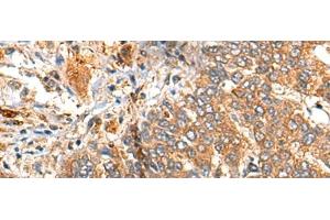 Immunohistochemistry of paraffin-embedded Human liver cancer tissue using MARK2 Polyclonal Antibody at dilution of 1:35(x200) (MARK2 antibody)