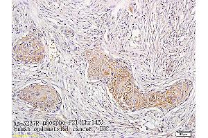 Formalin-fixed and paraffin embedded human endometrial cancer labeled with Anti-phospho-CDKN1A/P21 (Thr145) Polyclonal Antibody, Unconjugated (ABIN756862) followed by conjugation to the secondary antibody and DAB staining (p21 antibody  (pThr145))