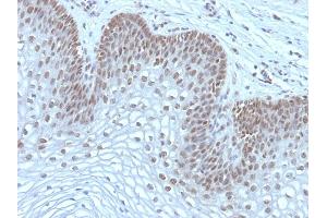 Formalin-fixed, paraffin-embedded human Cervical Carcinoma stained with MAP3K1 Mouse Monoclonal Antibody (2F6). (MAP3K1 antibody  (AA 1077-1176))