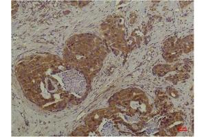 Immunohistochemical analysis of paraffin-embedded Human Breast Carcinoma using P44/42 MAPK (ERK1/2) Mouse mAb diluted at 1:200. (ERK1/2 antibody)