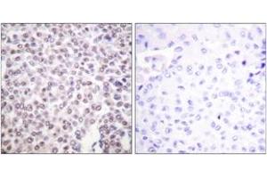 Immunohistochemistry analysis of paraffin-embedded human breast carcinoma tissue, using Histone H2B (Ab-5) Antibody. (Histone H2B antibody  (AA 1-50))