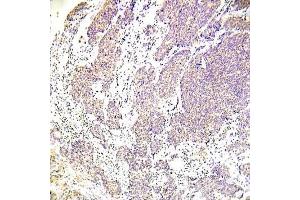 Immunohistochemical analysis of paraffin-embedded human lung adenocarcinoma tissue using CHK1 (Phospho-Ser317) Antibody (E012066). (CHEK1 antibody  (pSer317))